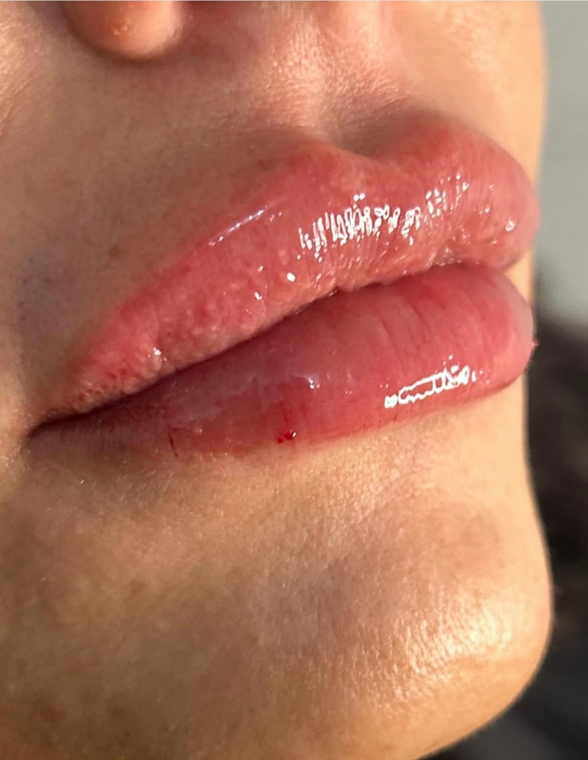 A client result photographed at Natt Aesthetics